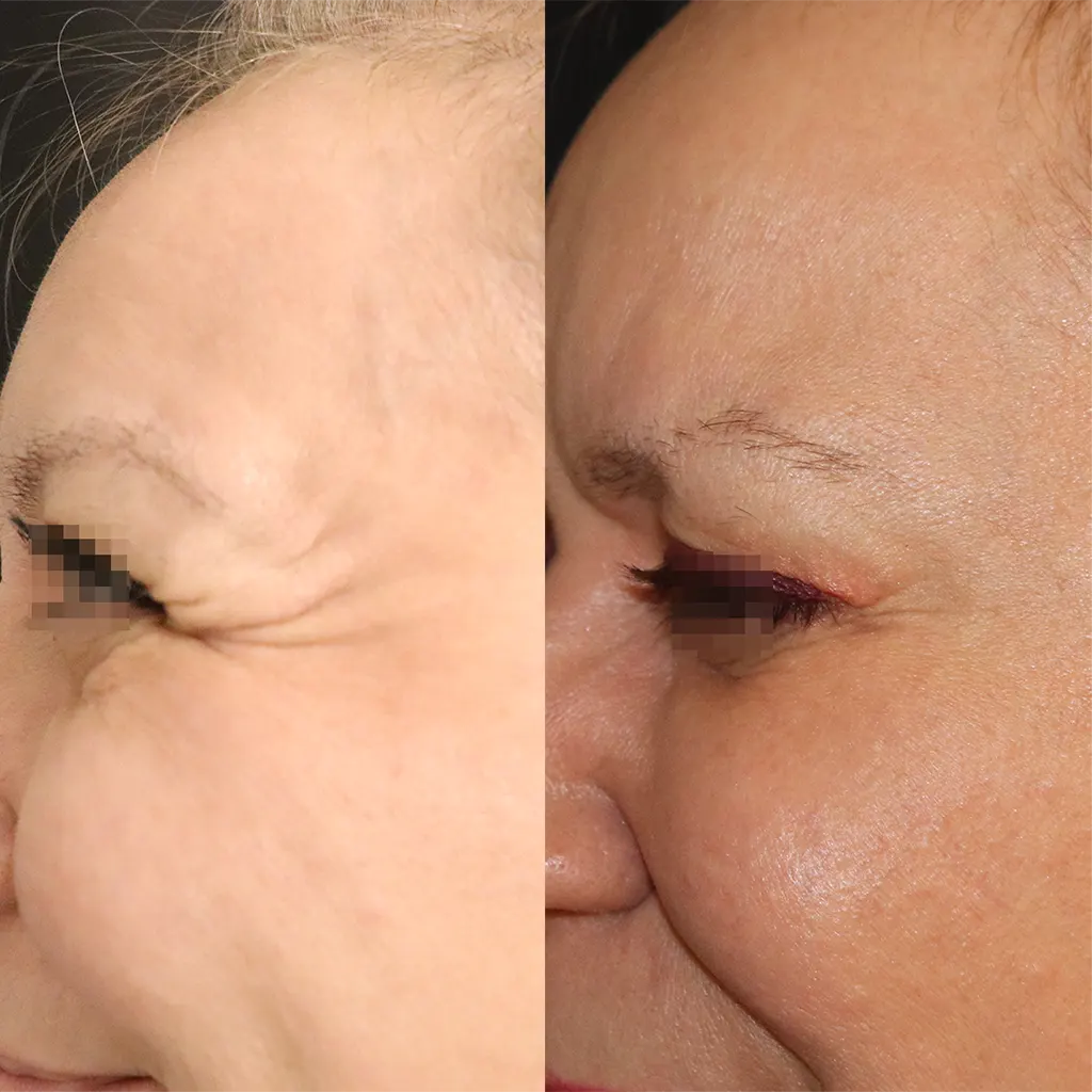 Botox - Μπότοξ μέσα αληθινές εικόνες Πριν και Μετά