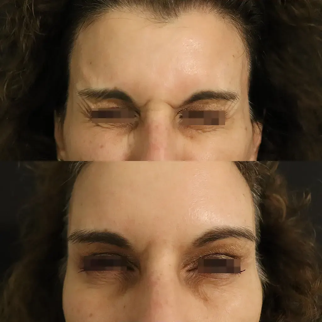 Botox - Μπότοξ μέσα αληθινές εικόνες Πριν και Μετά