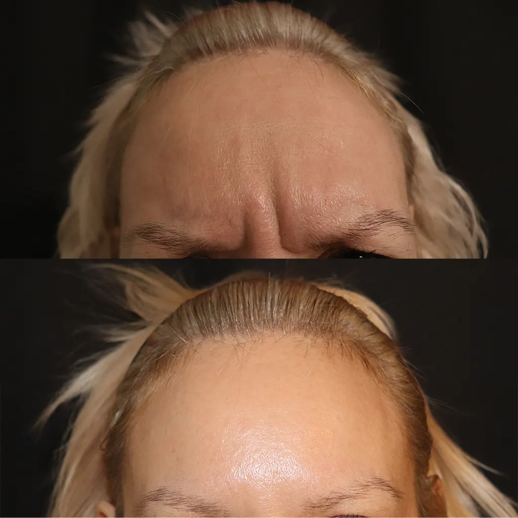 Botox - Μπότοξ μέσα αληθινές εικόνες Πριν και Μετά