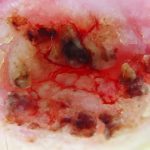 Ακανθοκυτταρικό καρκίνωμα σε έδαφος ακτινικής χειλίτιδας - πριν