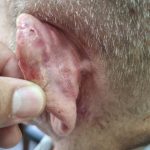 Καρκίνωμα σε αριστερό αυτί - Αποκατάσταση