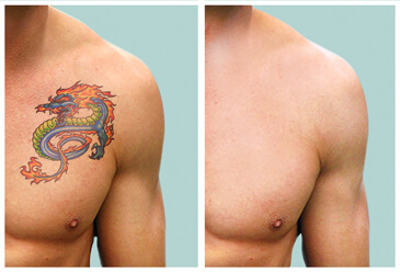αφαιρεση τατουαζ - tattoo removal
