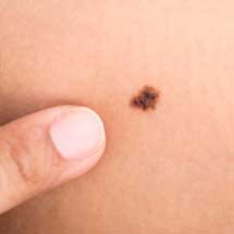 Καρκίνος του Δέρματος και Αφαίρεση Σπίλων