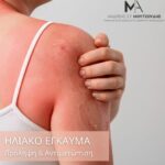 Ηλιακό έγκαυμα: Προστατεύστε το δέρμα σας όλο τον χρόνο